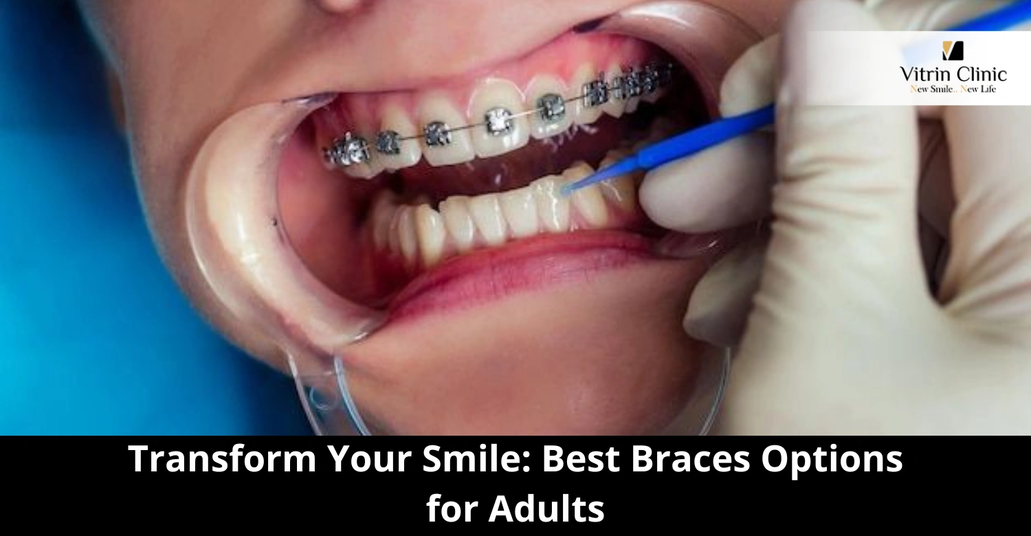 Best Braces for adults Options & Costs
